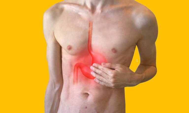 reflux